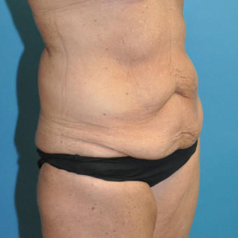 Pre op bodylift right oblique