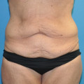 Pre op bodylift anterior this one