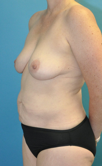 Pre op left oblique mommy makeover