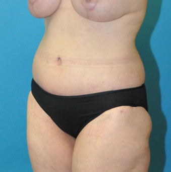 Post op 3 months lower body lift left oblique