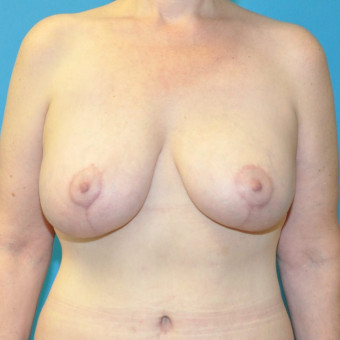 Post op breasts anterior 3 months