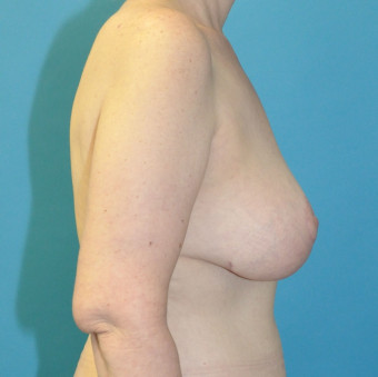 Post op breasts right lateral 3 months