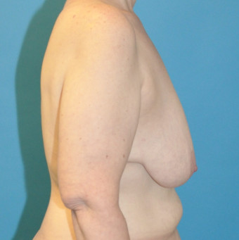 Pre op breasts right lateral
