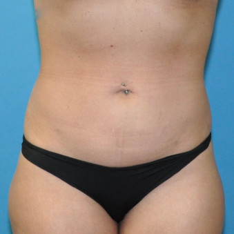 Post op anterior abdomen no tattoo