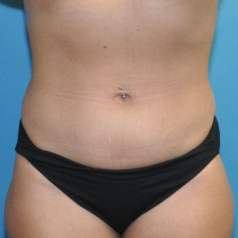 Pre op anterior abdomen no tattoo