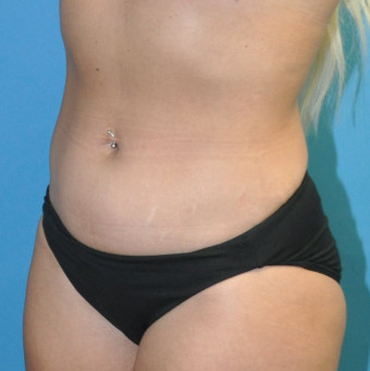 Pre op left oblique abdomen