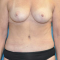 Post op breast and abdomen anterior