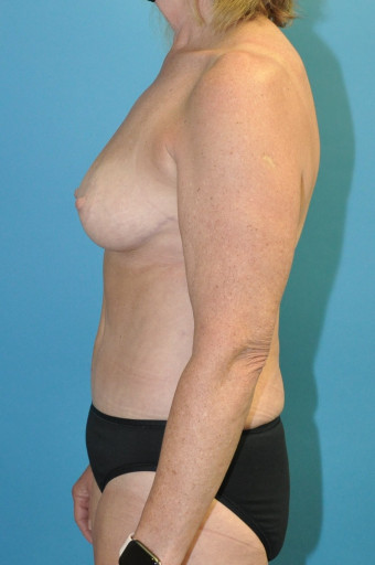 Post op breasts and ab left lateral 