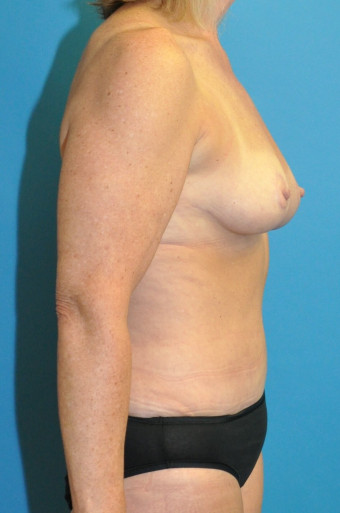 Post op breasts and abdomen right lateral