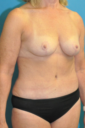 Post op breasts and abdomen right oblique