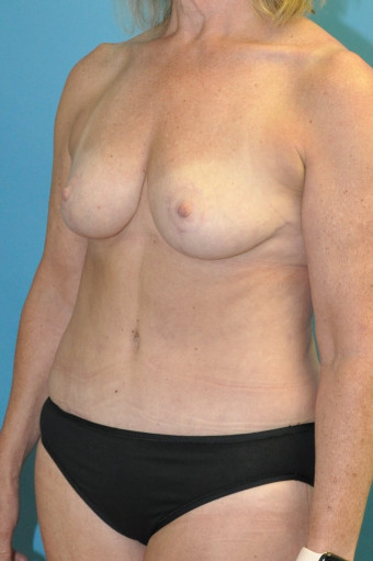 Post op left oblique breasts and abdomen 