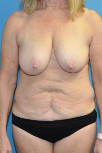 Pre op anterior breasts and abdomen