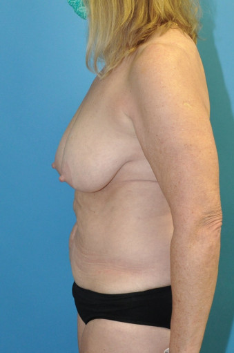 Pre op breasts and abdomen left lateral 