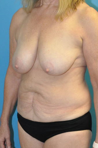 Pre op breasts and abdomen left oblique USE