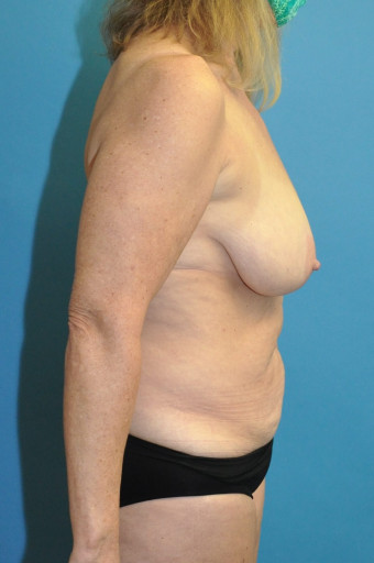 Pre op breasts and abdomen right lateral