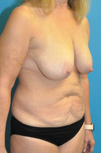 Pre op breasts and abdomen right oblique USE