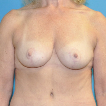 Post op breasts anterior