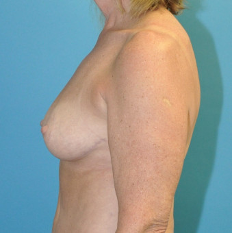 Post op breasts left lateral