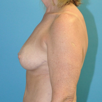 Post op breasts left lateral