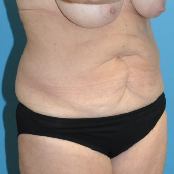 Pre op abdomen right oblique