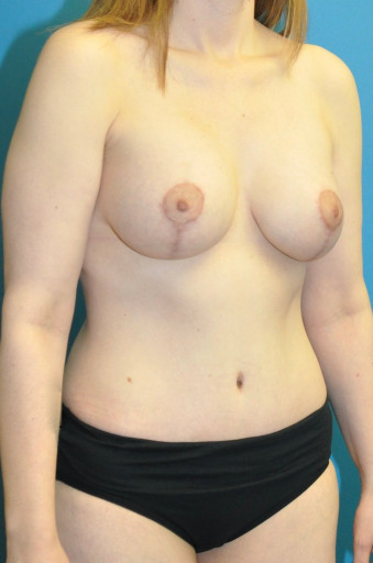 Breast and body Post op 6 months right oblique