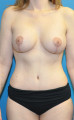 Post op breasts and abdomen anterior 6 months