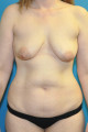 Pre op anterior breasts and body