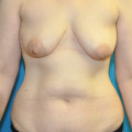 Pre op anterior breasts and body