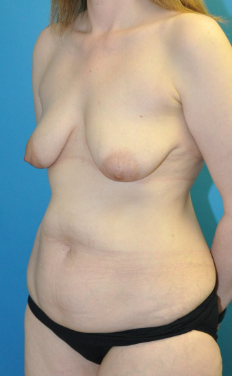 Pre op breasta and abdomen left oblique
