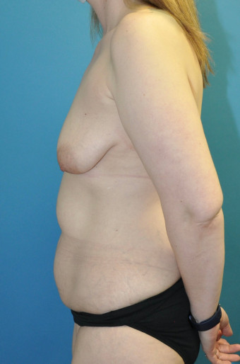 Pre op breasts and abdomen left lateral