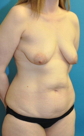 Pre op breasts and abdomen right oblique