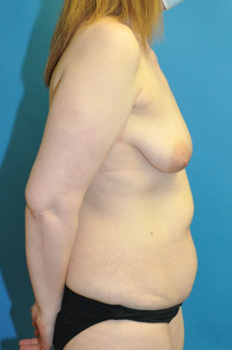 Pre op right lateral breasts and abdomen