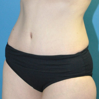 Abdomen post op left oblique