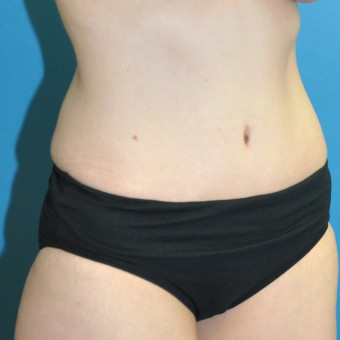 Abdomen post op right oblique