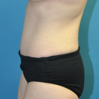 Post op abdomen left lateral 