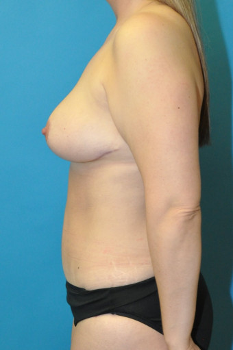 Post op breasts and body left lateral 