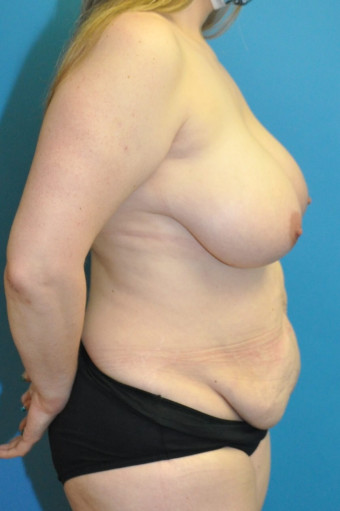 Pre op breasts and body right lateral 