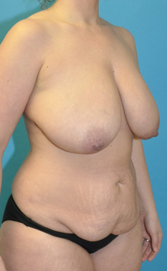 Pre op breasts and body right oblique