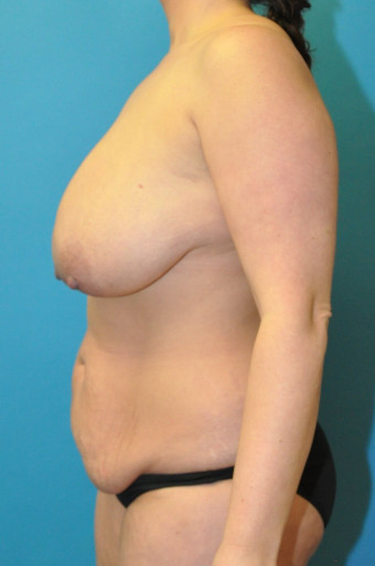 Pre op left lateral  2