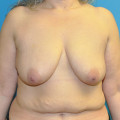 Pre op breasts anterior