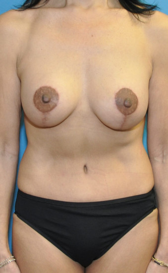 Post op 4 months anterior breasts and abdomen