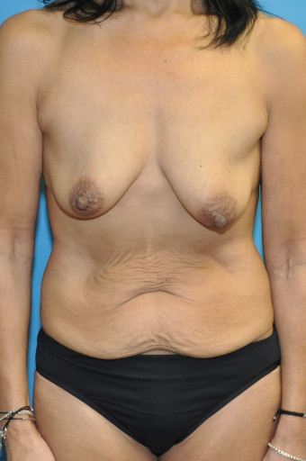 Pre op anterior breasts and abdomen