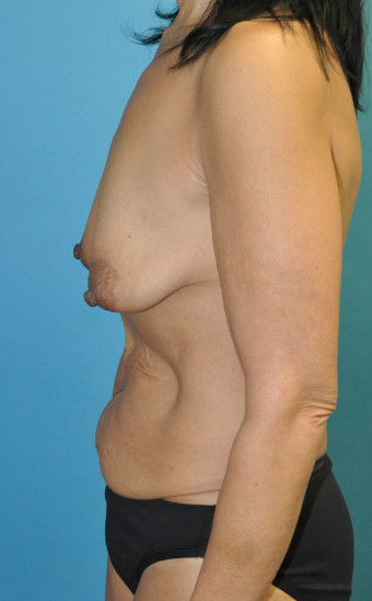 Pre op left lateral mmakeover