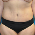 Post op abdomen anterior cropped 9 months