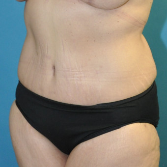 post op left oblique abdomen 9 months