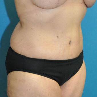 Post op 9 months abdomen right oblique