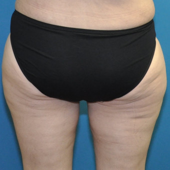 Post op posterior thigh lift