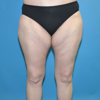 Pre op anterior thigh lift