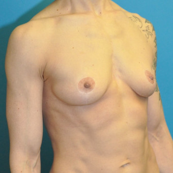 Post op right oblique