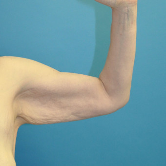 Pre op left arm medial